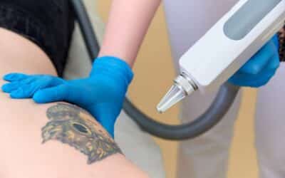 ¿Cómo funciona la eliminación de tatuajes con láser?