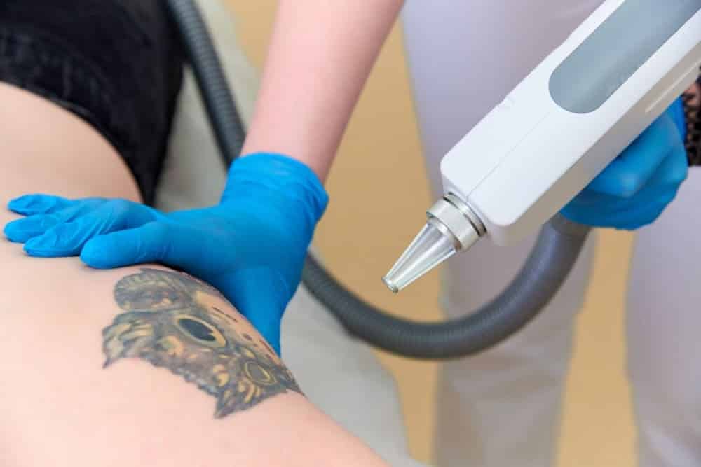 procedimiento eliminación tatuaje laser